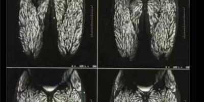 Body Full of Parasite